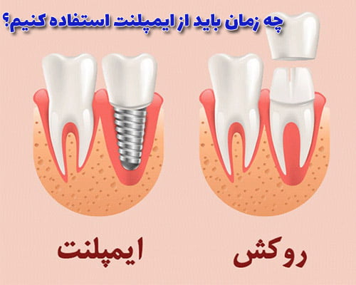 چه زمان باید از ایمپلنت استفاده کنیم؟