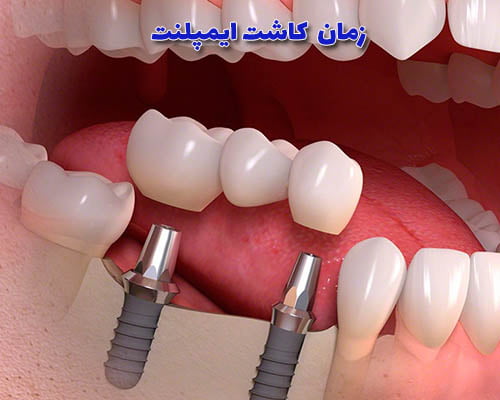 زمان کاشت ایمپلنت
