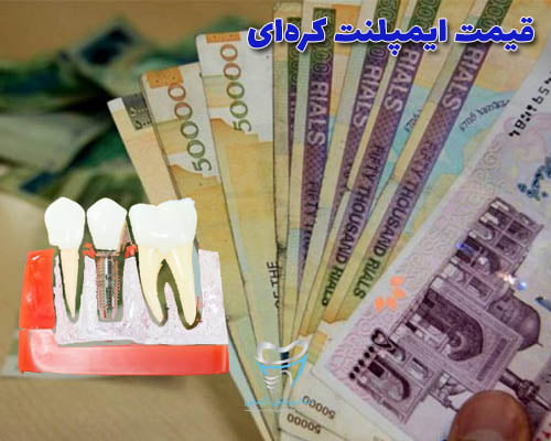 قیمت ایمپلنت کره ای به این موضوع مربوط است که کدام شرکت ایمپلنت در کره ای جنوبی تولید کرده است
