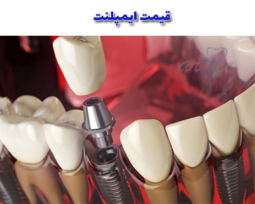 قیمت ایمپلنت