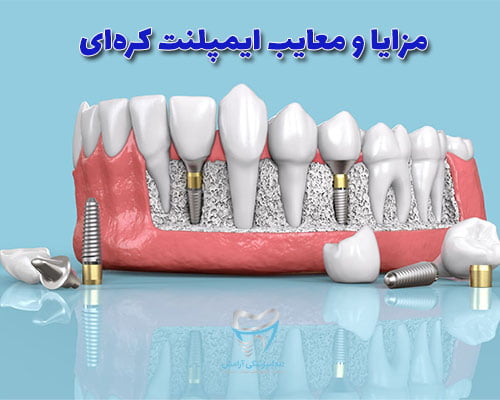 به طور کل ایمپلنت کره ای یا هر نوع ایمپلنت دیگر عیبی به جز هزینه بالا ندارند.
