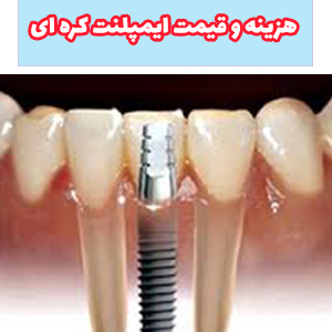 ایمپلنت دندان کره ای، ترکیبی از پیشرفت تکنولوژی و زیبایی طبیعی را به ما عرضه می‌کنند.
