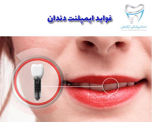 یک صورت و یک لبخند زیبا با Dental implant
