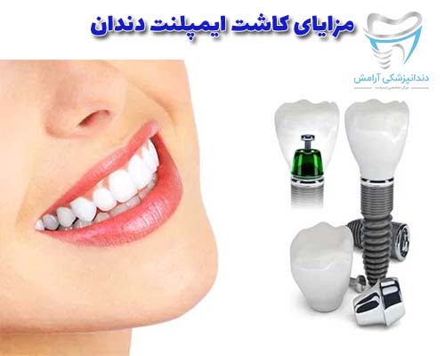 لبخند و چهره ای زیباتر با ایمپلنت خواهید داشت