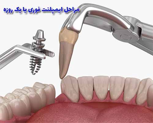 جراحی ایمپلنت دندان فوری یا یک روزه، یک فرآیند پیشرفته است که به بیماران امکان می‌دهد.