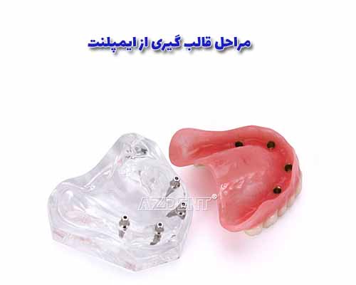 مراحل قالب‌گیری از ایمپلنت دندان، مراحلی هستند که پس از جراحی ایمپلنت و قبل از ترمیم دائمی (ترمیم دندان دائمی یا پل دائمی) انجام می‌شوند. 