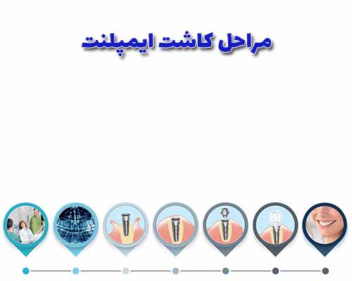 مراحل کاشت ایمپلنت دندان با در نظر گرفتن تصویربرداری اولیه و جراحی دقیق در فک، ایجاد محیطی مثال زدهشده برای پیوند استخوان و در نهایت، نصب دندان مصنوعی، انجام میشود.
