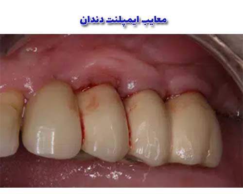 معایب ایمپلنت دندان می‌تواند شامل عدم ترازبندی صحیح که منجر به مشکلات در قفل شدن غذا می‌شود، باشد.