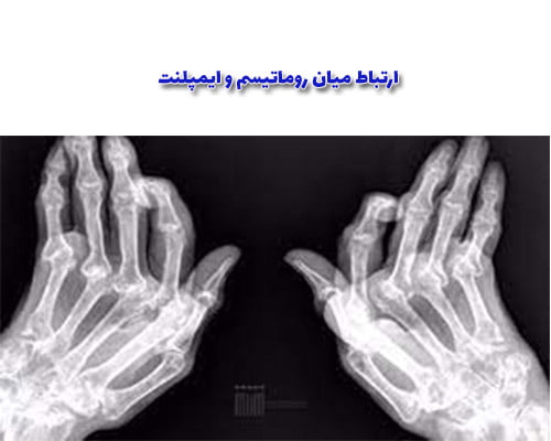 بیمارانی که به روماتیسم مبتلا هستند، ممکن است دارای مشکلات مفاصلی و اتصال بافتی باشند که می‌تواند به کاهش پایداری ایمپلنت‌های دندانی منجر شود و باعث مشکلات در موفقیت ایمپلنت گردد.