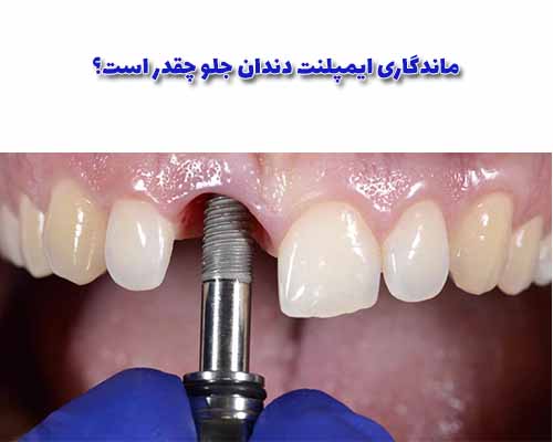 ماندگاری ایمپلنت دندان جلو به عوامل متعددی بستگی دارد و ممکن است متفاوت باشد.