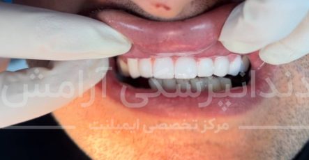 چرا نباید بیماران آرتریت روماتوئید، ایمپلنت دندان انجام دهند؟