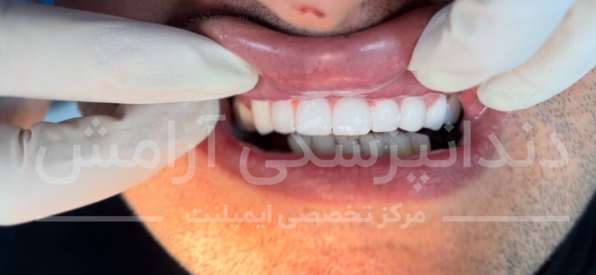 چرا نباید بیماران آرتریت روماتوئید، ایمپلنت دندان انجام دهند؟
