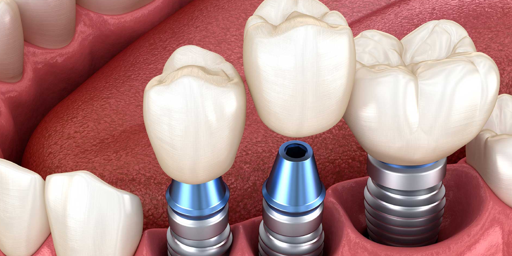 بررسی ایمپلنت دندان آسیاب
