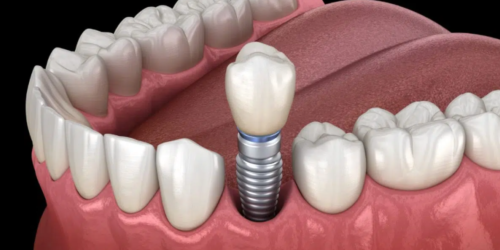 اجزا ایمپلنت دندان آسیاب