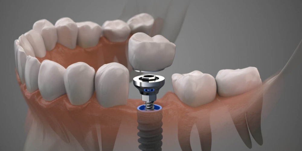 جایگزین ایمپلنت دندان آسیاب
