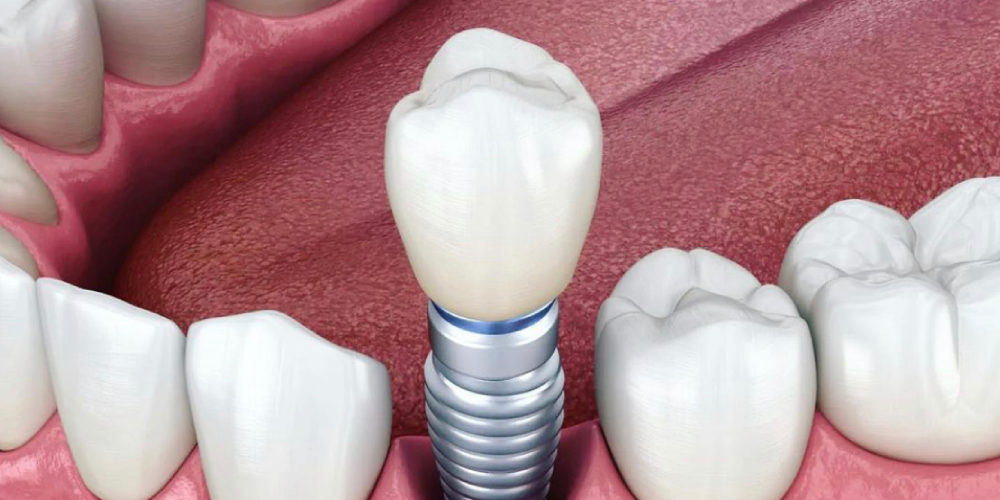 انواع ایمپلنت دندان آسیاب