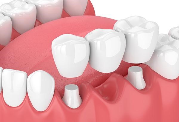 بریج های ثابت دندانی (Fixed Dental Bridges)