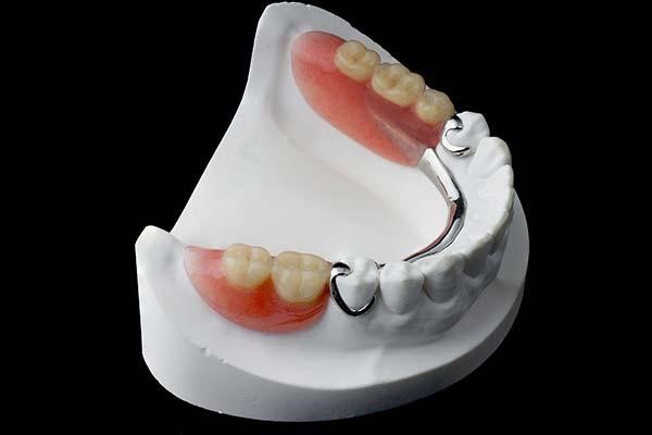 پروتزهای جزئی متحرک (Removable Partial Dentures)