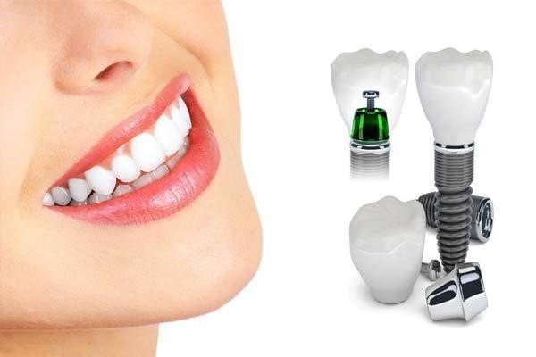 ایمپلنت همزمان با کشیدن دندان