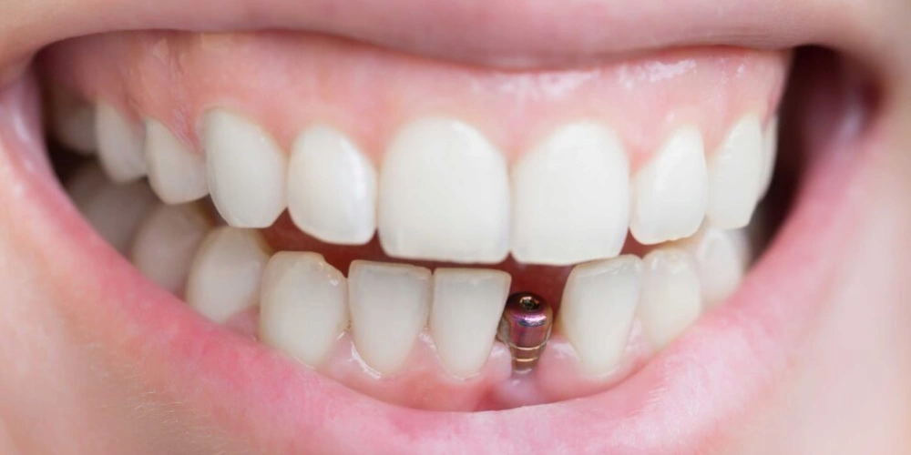 ایمپلنت همزمان با کشیدن دندان چه مزایایی دارد؟