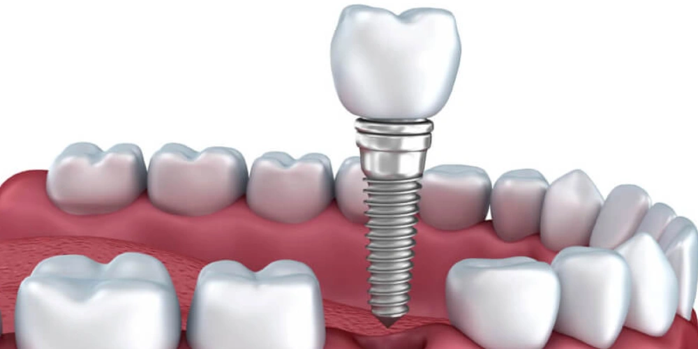 ایمپلنت همزمان با کشیدن دندان چه معایبی دارد؟