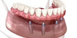 آشنایی با پروتزهای دندانی