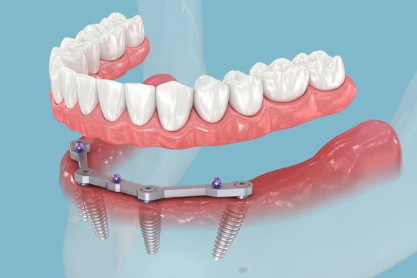 ایمپلنت به روش All on 4