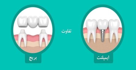 تفاوت ایمپلنت دندان و بریج دندان چیست؟ مقایسه ایمپلنت با بریج دندان