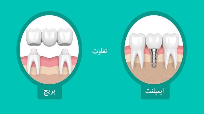 تفاوت ایمپلنت دندان و بریج دندان چیست؟ مقایسه ایمپلنت با بریج دندان