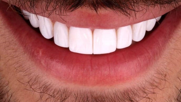 مقایسه لمینت و کامپوزیت