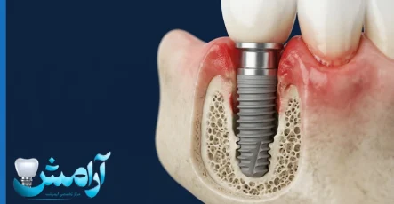پس زدن ایمپلنت دندان: علائم، علل و روش‌های درمان (راهنمای کامل 2026)