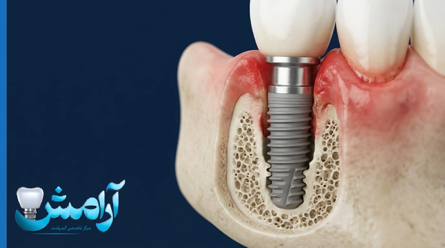 پس زدن ایمپلنت دندان