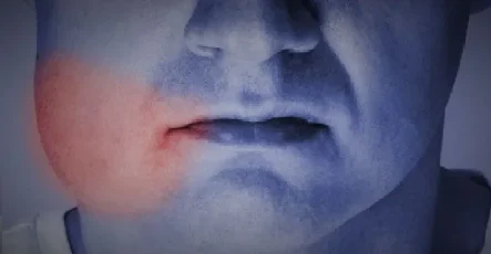 علت ورم صورت بعد از ایمپلنت دندان به همراه درمان