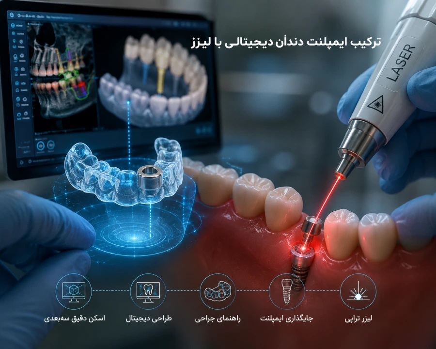 ترکیب ایمپلنت دندان دیجیتالی با لیزر