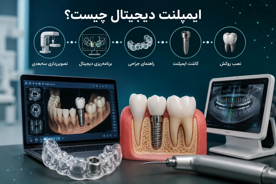 ایمپلنت دیجیتال چیست؟