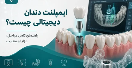 ایمپلنت دندان دیجیتالی چیست؟ راهنمای کامل مراحل، مزایا و معایب