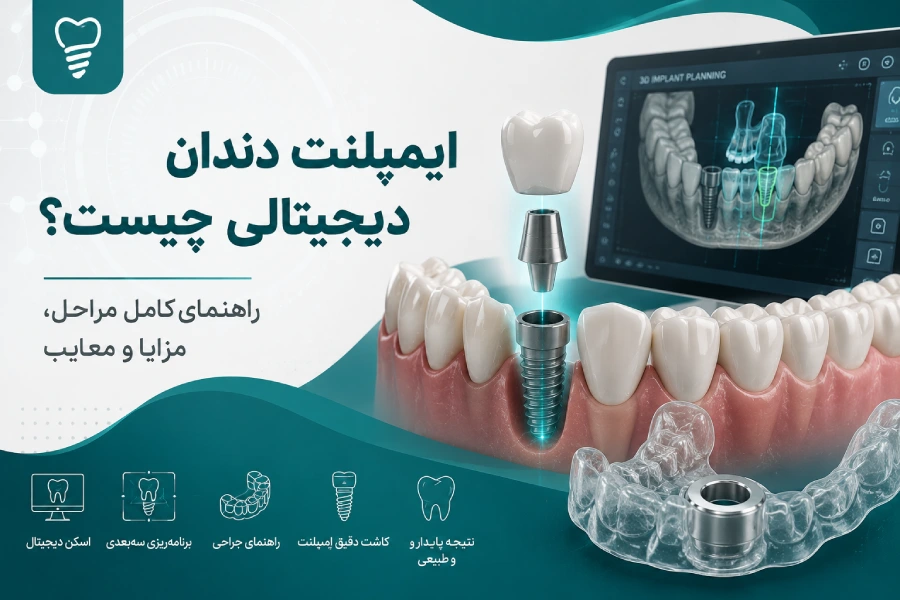 ایمپلنت دندان دیجیتالی چیست