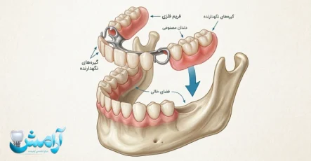 پروتز دندان چیست؟ راهنمای تخصصی انواع، فناوری ساخت، هزینه و نگهداری