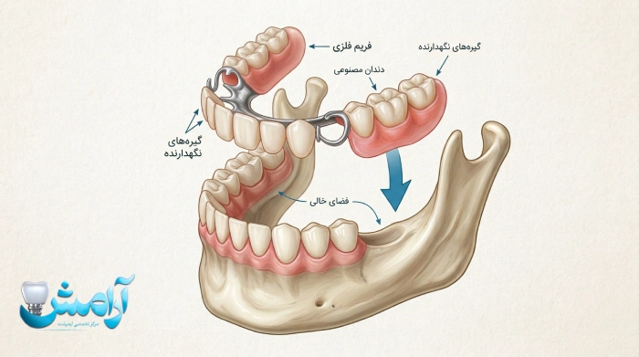 پروتز دندان