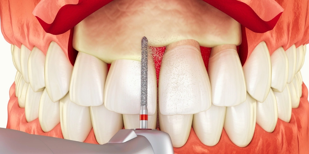 آشنایی با انواع جراحی لثه