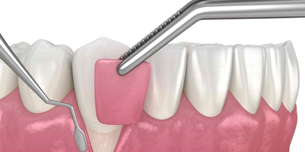 جراحی لثه مناسب کیست؟