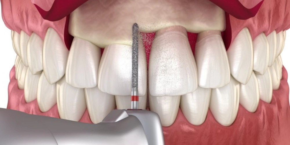 دوران نقاهت جراحی لثه چه مدت است؟