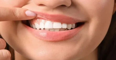 جراحی لثه چیست؟