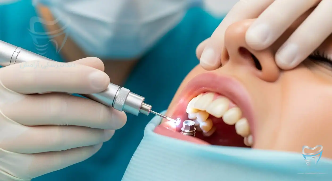 تصویر دندانپزکی در حال ایمپلنت دندان با لیزر