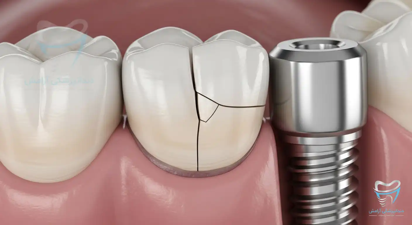ایمپلنت دندان شکسته