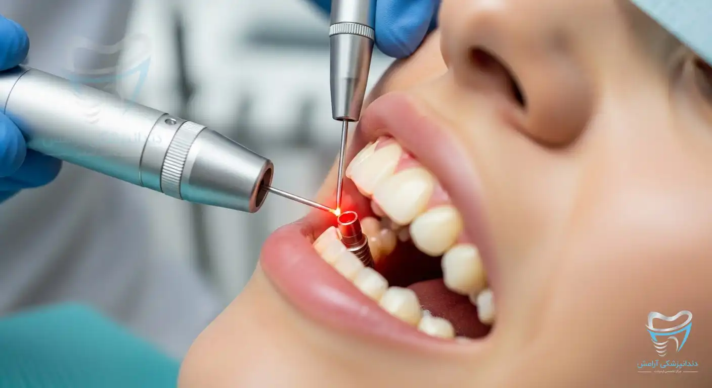 تصویری برای قیمت ایمپلنت با لیزر