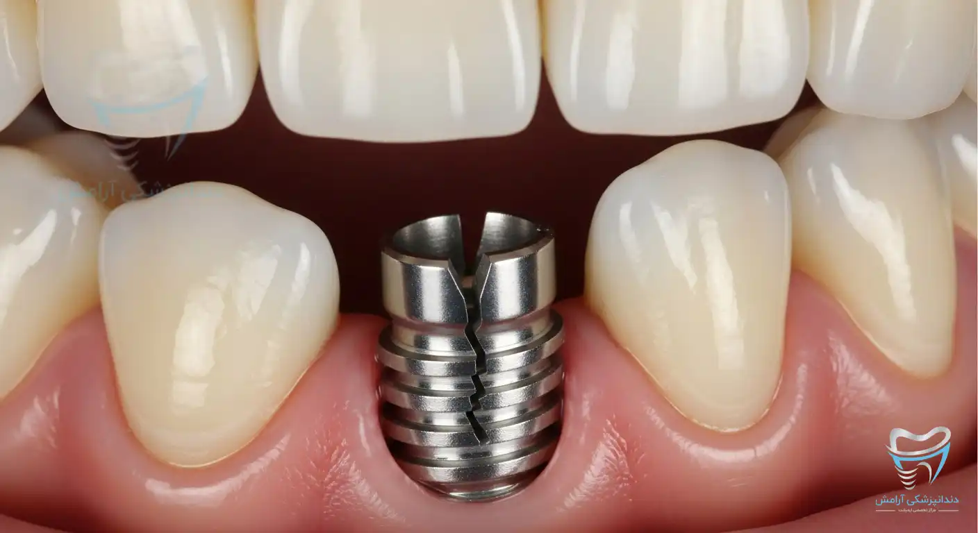 تصویر نحوه ایمپلنت شکسته