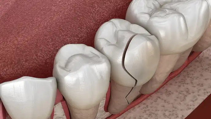 ایمپلنت دندان شکسته