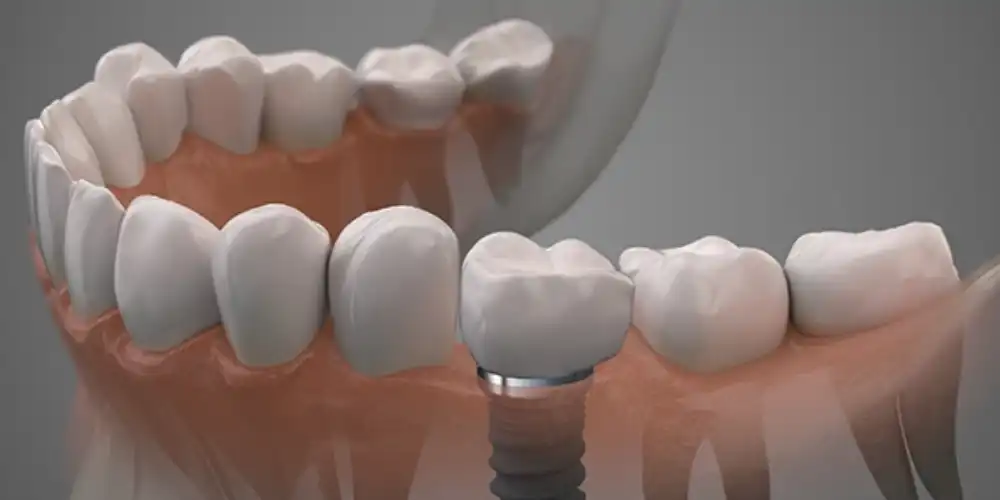 جزئیات ایمپلنت فک بالا سخته یا پایین