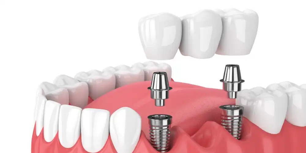 نکات و جزئیات قیمت هیلینگ اباتمنت